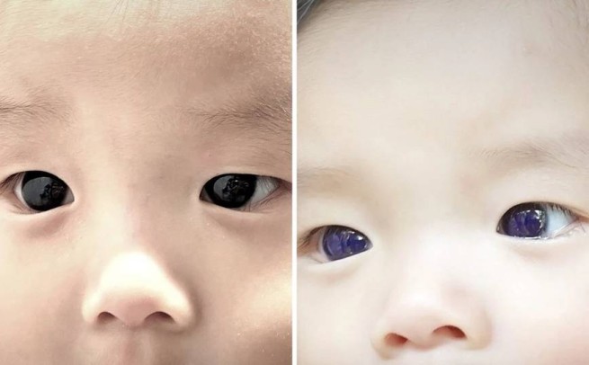 Карие глаза младенца стали голубыми после приема лекарства от коронавируса