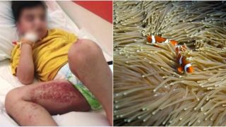 Дети пострадали от медуз, купаясь в море